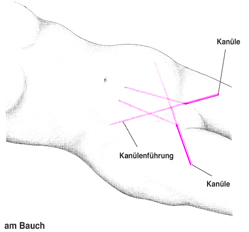 Fettabsaugung am Bauch