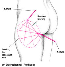 Fettabsaugung am Bein