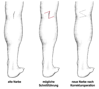 Narbenkorrektur am Bein