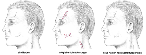 Narbenkorrektur im Gesicht